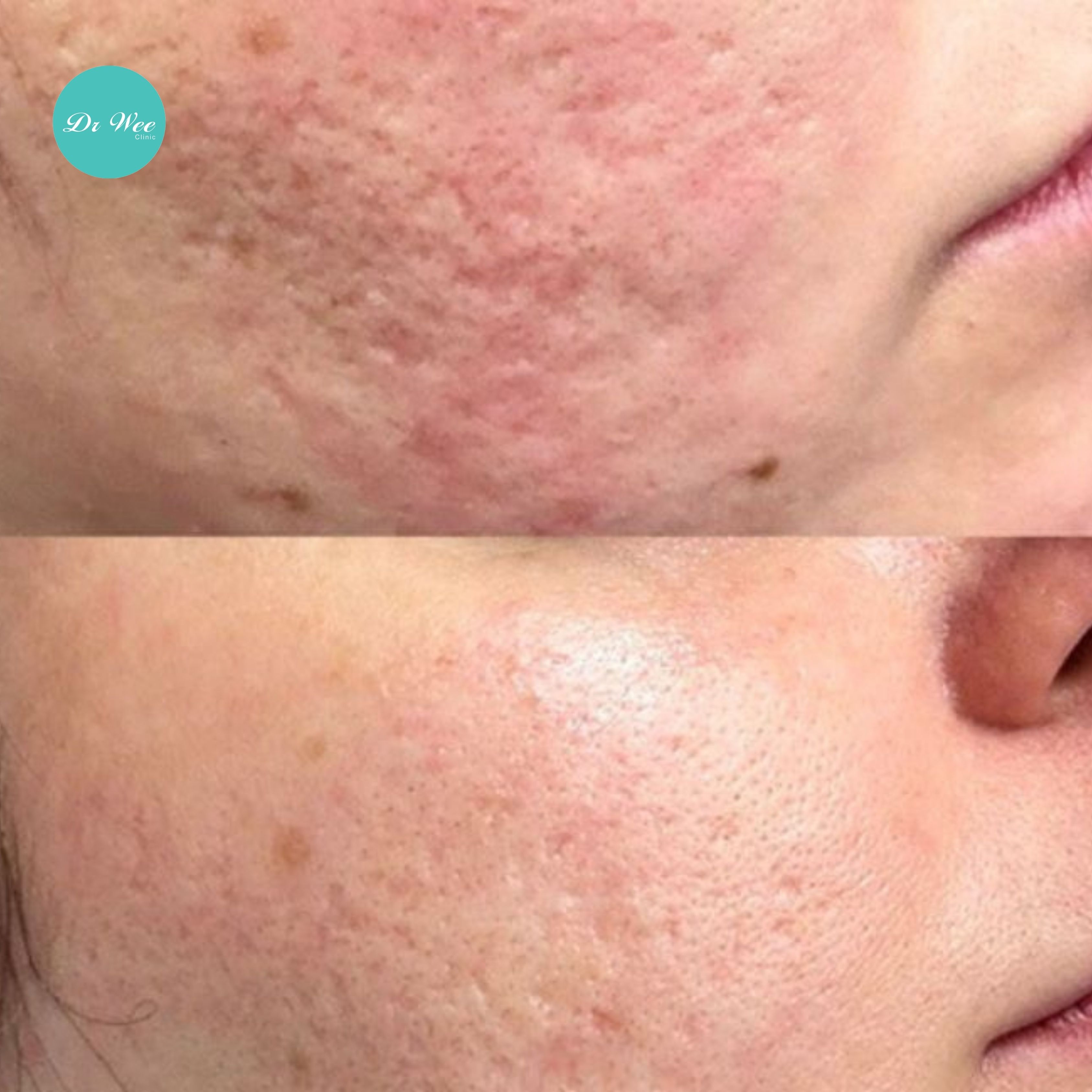 Dr Wee Clinic 凹陷型痘坑疤痕修复与毛孔粗大激光治疗