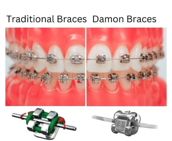 Damon Braces vs Traditional Braces