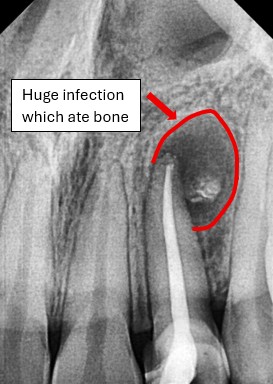 Before root canal showing large infection