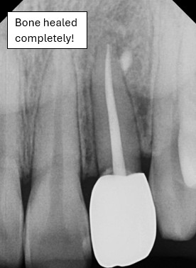 After root canal bone healed completely