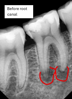 Before root canal infection visible