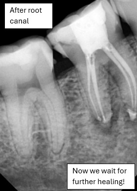 After root canal healing progress