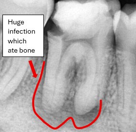 Before root canal severe infection damaging bone