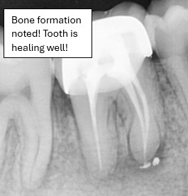 After root canal bone formation and healing
