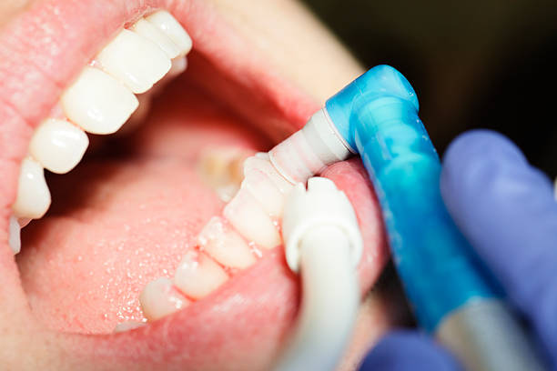 Porcelain Veneers