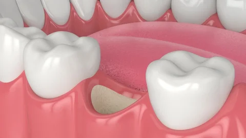Damon Braces