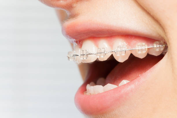 Ceramic Braces
