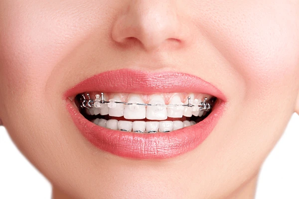 Damon Braces