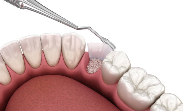 Damon Braces