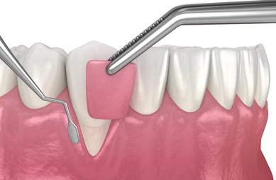 Ceramic Braces