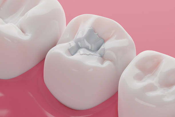 Metal Braces