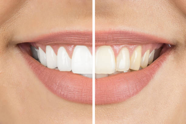 Whiter & Brighter Smile
