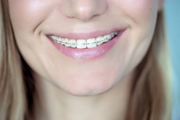 Ceramic Braces