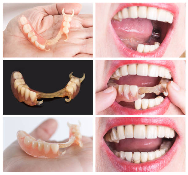 Flexible Dentures