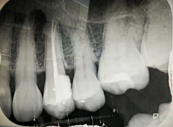 IOPA Intraoral Periapical X-ray