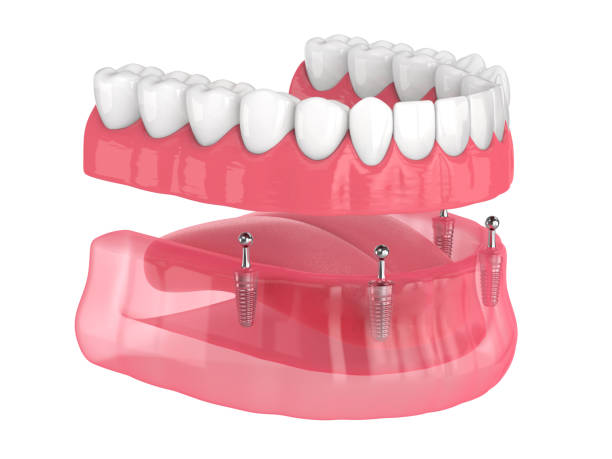Implant-Supported Dentures