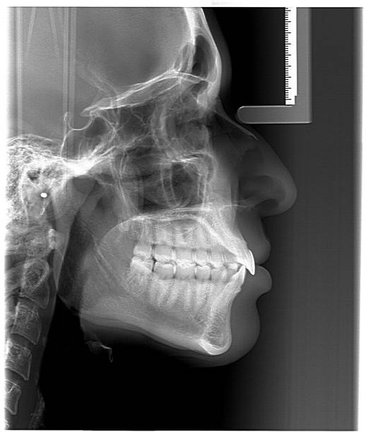 Lateral Cephalometric