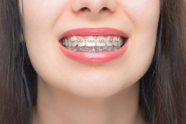 Metal Braces