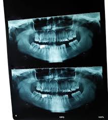 OPG Orthopantomogram