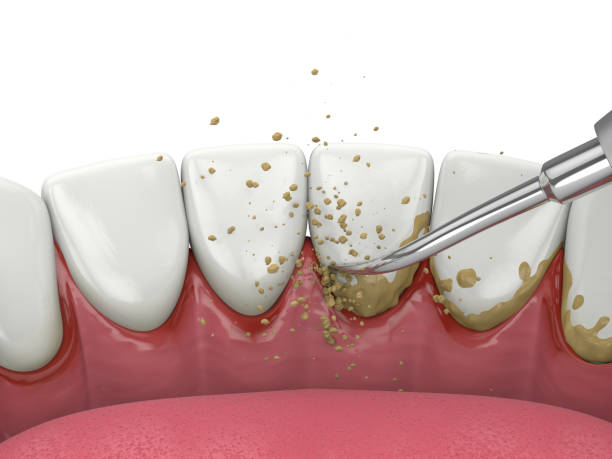 Removes Plaque & Tartar