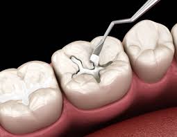 Restores Tooth Structure