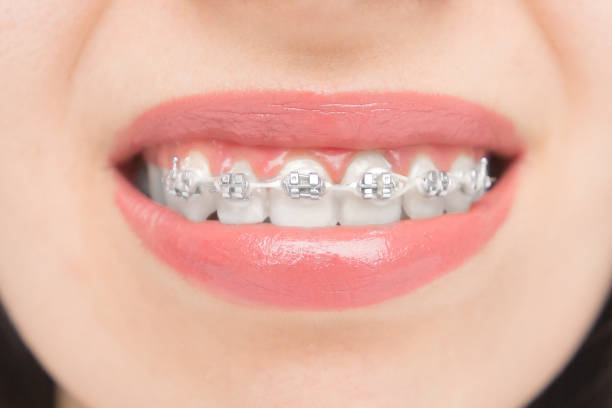 Self-Ligating Braces