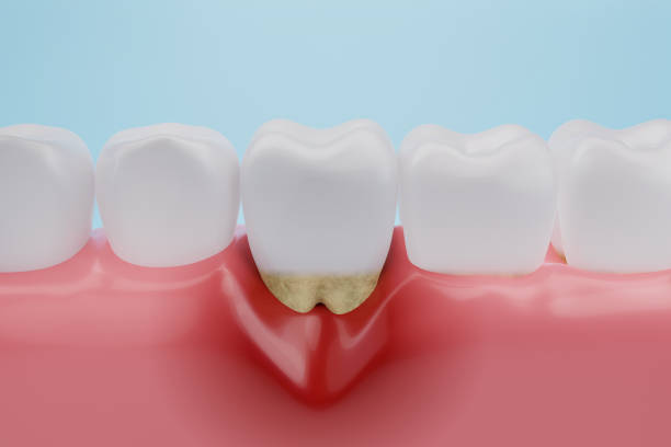 Prevents Gum Disease
