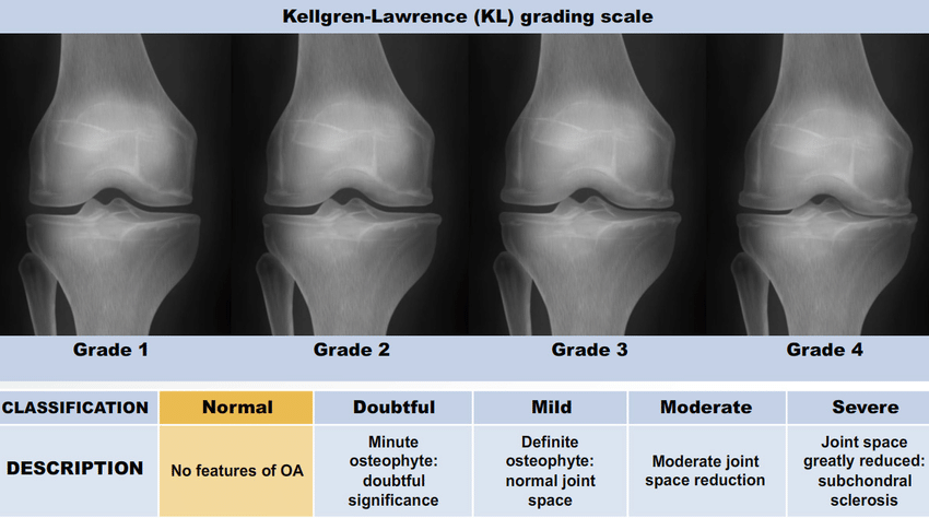 OA X-ray Grades