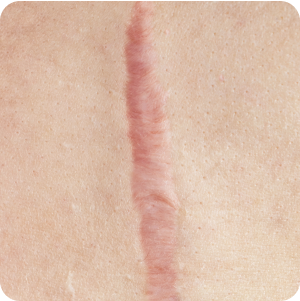 Hypertrophic Scars