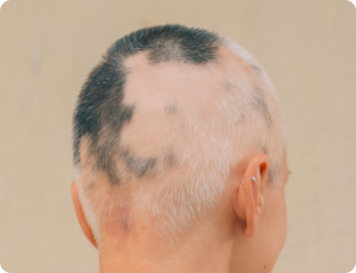 Alopecia Areata Pixel Clinic