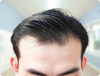 Telogen Effluvium Pixel Clinic