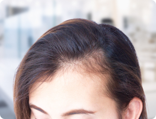 Traction Alopecia Pixel Clinic