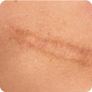 Keloid Scars