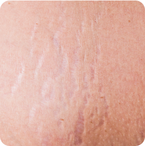 Stretch Marks