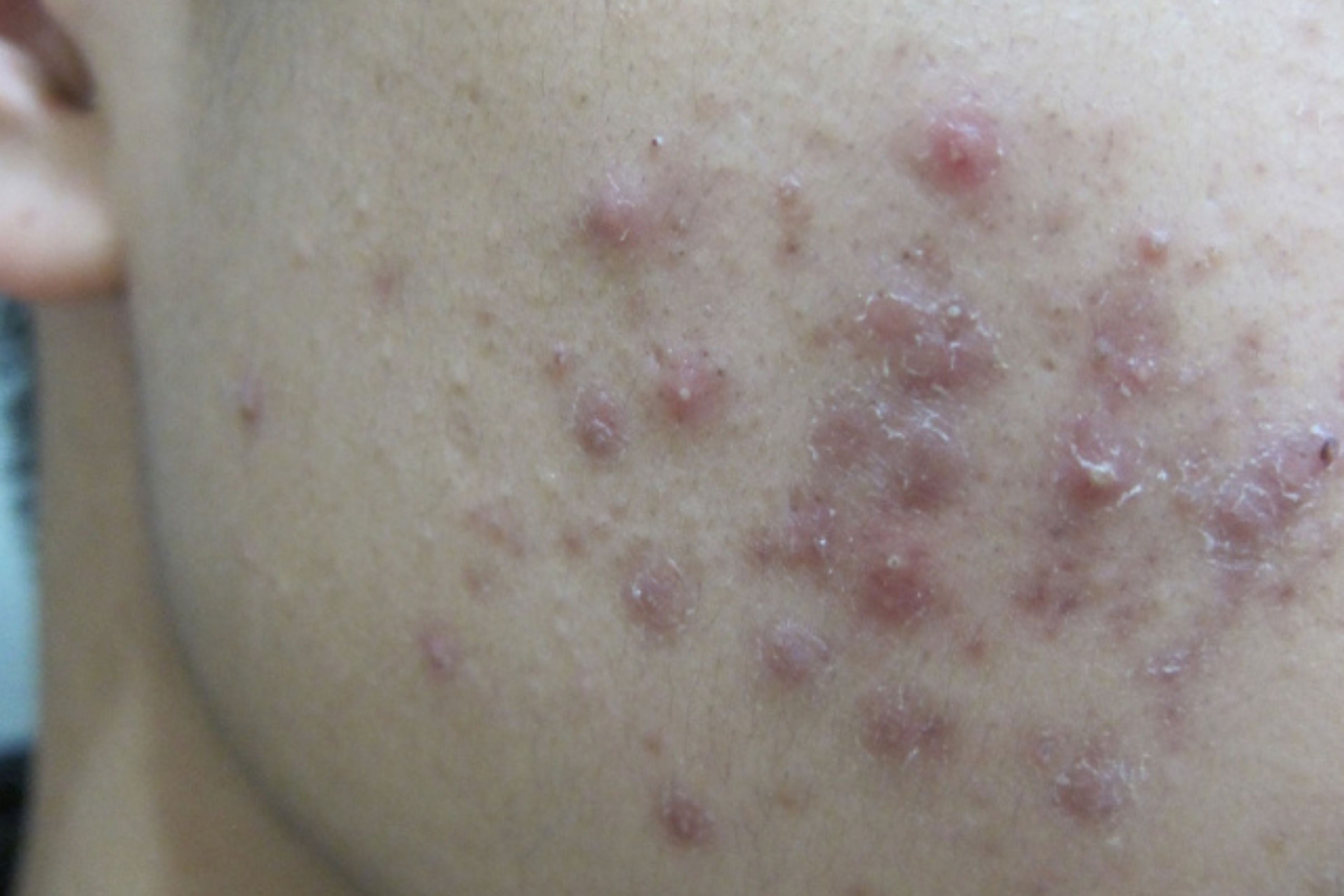 Ablasi laser pecahan kontur dan penyampaian tenaga terma radiofrekuensi dalam - Dr Wee Clinic