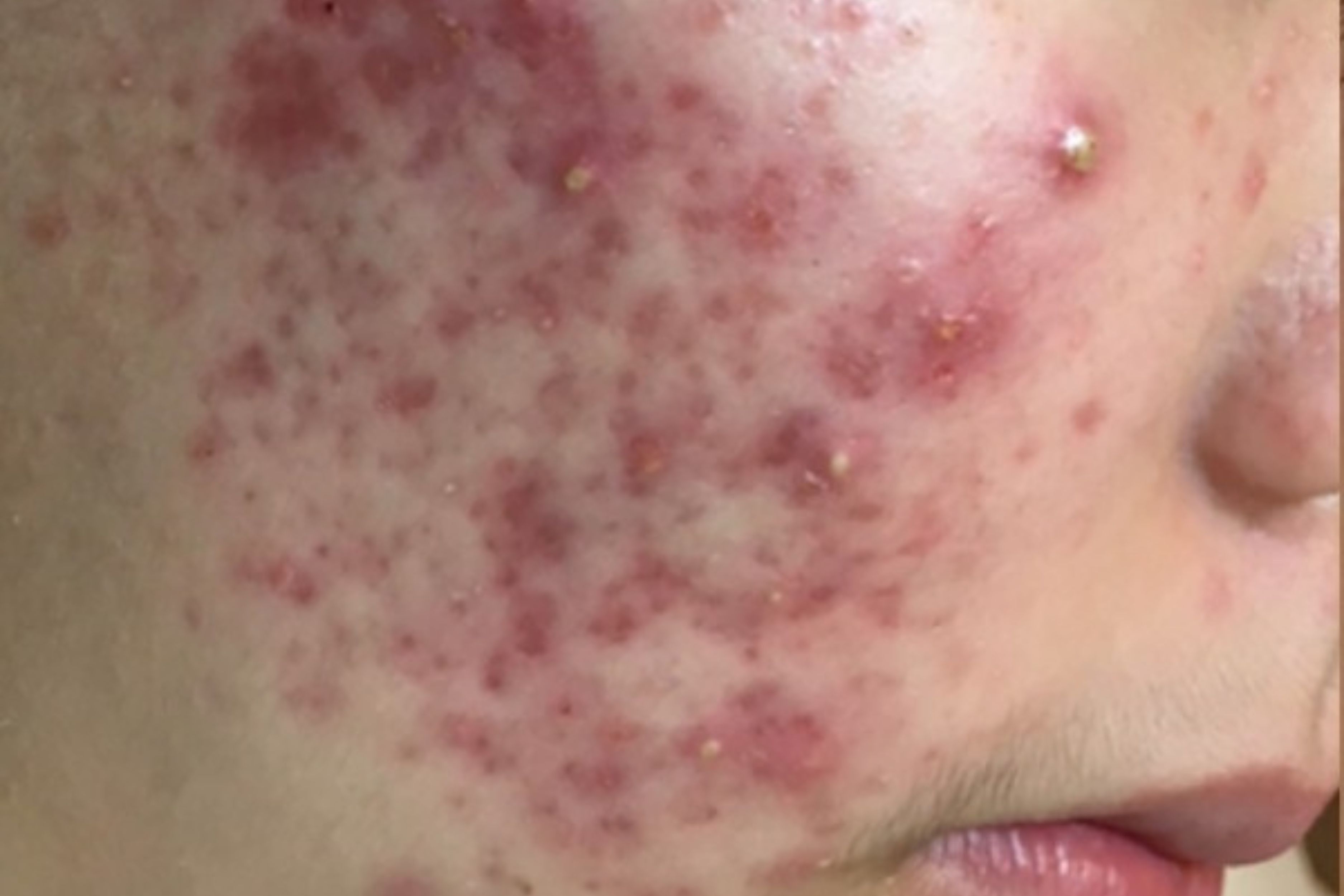 Subcision pembedahan untuk parut jenis rolling yang teruk berpaut oleh tisu gentian dalam - Dr Wee Clinic