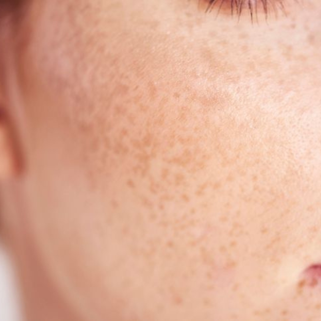 Targeted pulverization of actinic sun spots and age patches using Pico Laser