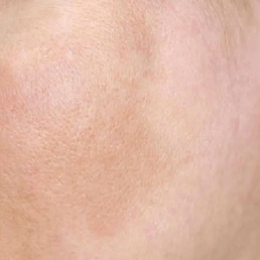 Full face skin toning scan with Pico Laser for eliminating regional dyschromia and dullness
