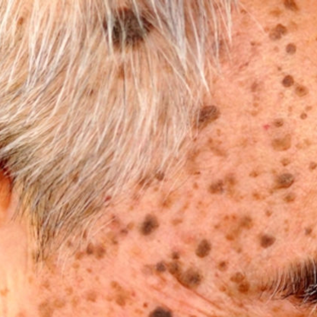 Symmetric smoothing and pigment clearing of elevated seborrheic keratosis warty plaques