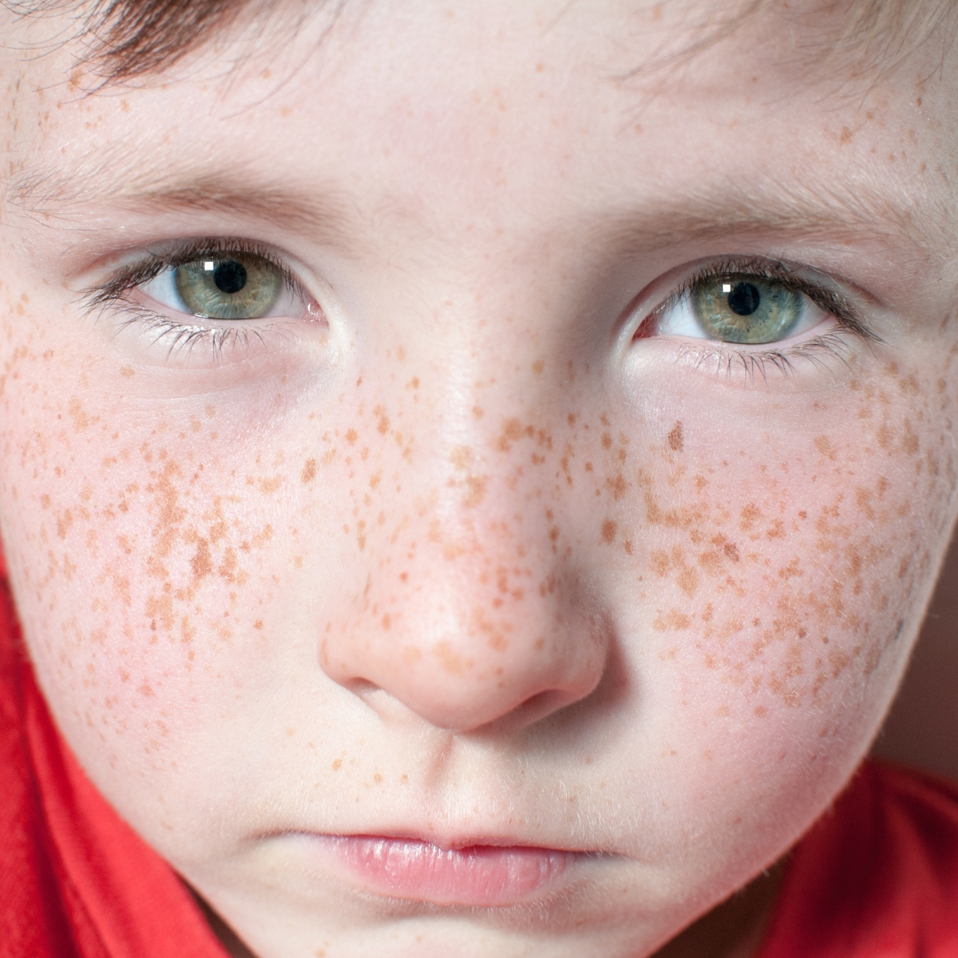 Shallow epidermal freckles clearance with advanced picosecond acoustic technology