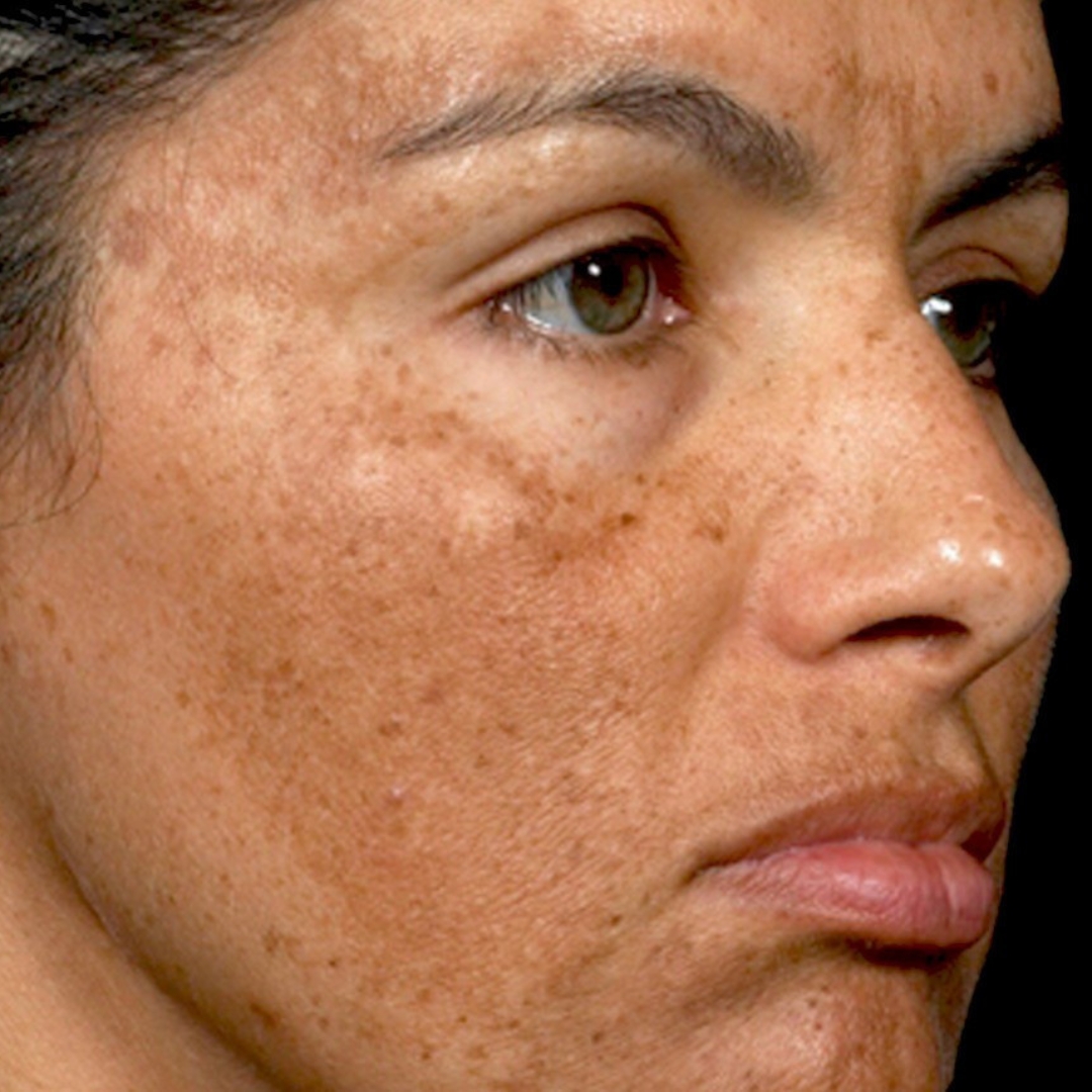 Before and after clinical results for melasma patchy pigmentation removal with Pico Laser treatment