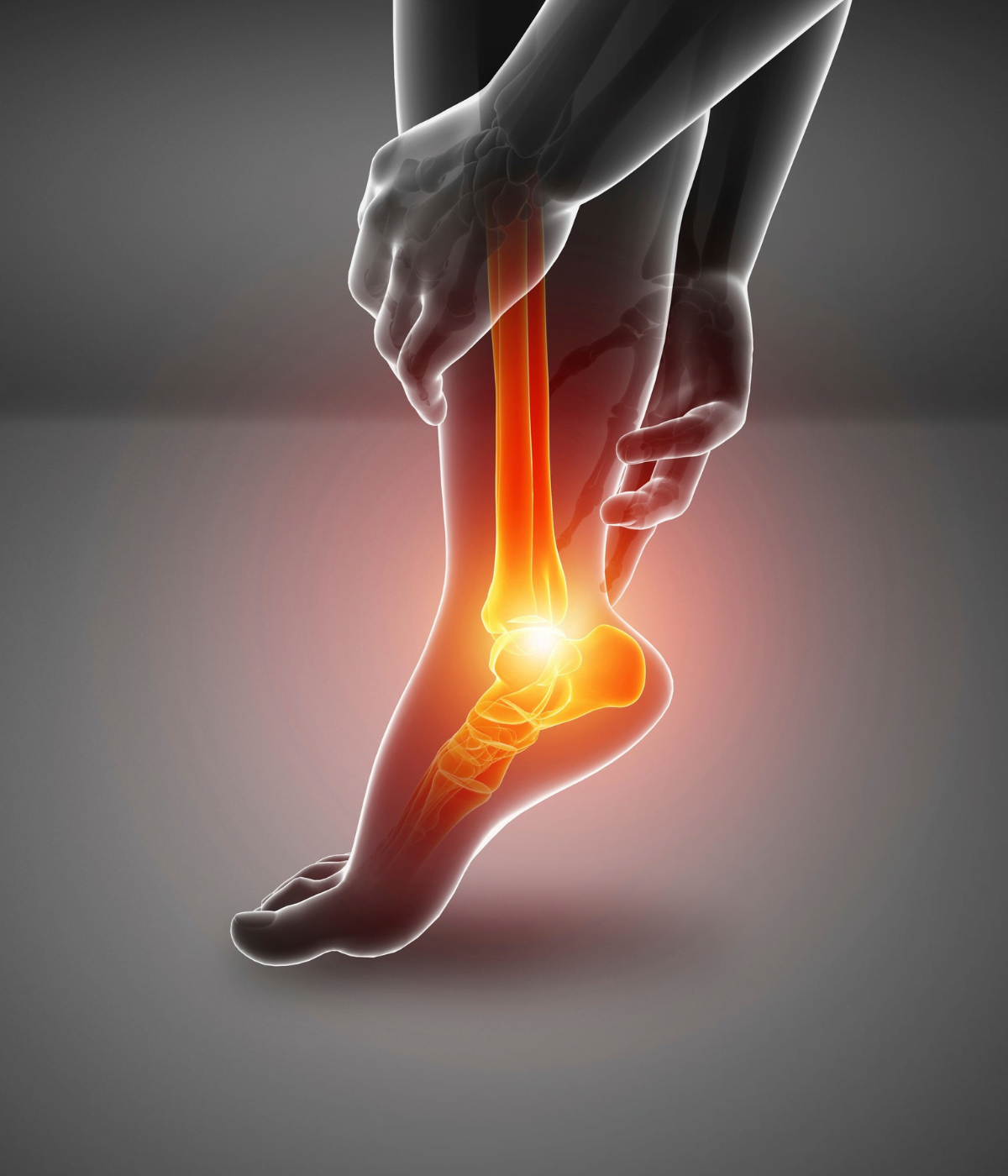 Plantar Fasciitis Illustration 2